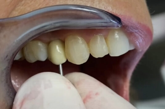 Inseriamo il dente sull’impianto. Guarda com’è semplice!